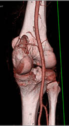 Metastatic Renal Cell Carcinoma - CTisus CT Scan