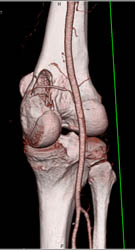 Metastatic Renal Cell Carcinoma - CTisus CT Scan