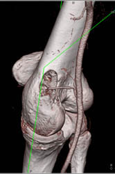 Metastatic Renal Cell Carcinoma - CTisus CT Scan