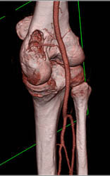 Metastatic Renal Cell Carcinoma - CTisus CT Scan