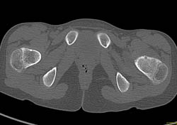 Osteoid Osteoma - CTisus CT Scan