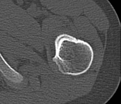 Osteoid Osteoma - CTisus CT Scan