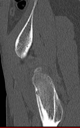 Osteoid Osteoma - CTisus CT Scan