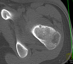 Osteoid Osteoma - CTisus CT Scan