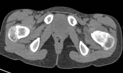 Osteoid Osteoma - CTisus CT Scan