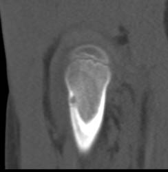 Osteoid Osteoma - CTisus CT Scan