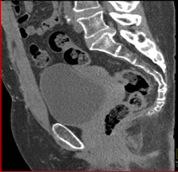 L5-s1 Disc - CTisus CT Scan