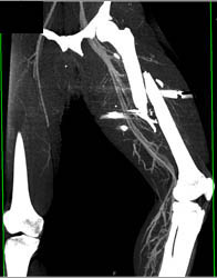 Femur Fracture Without Vascular Injury - CTisus CT Scan