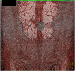 DIEP Flap Planning - CTisus CT Scan