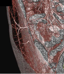 DIEP Flap Planning - CTisus CT Scan