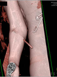 Rod Pushed Into Arm- Ouch - CTisus CT Scan