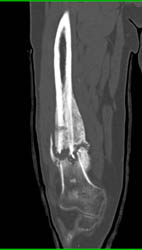 Non-union Femur - CTisus CT Scan