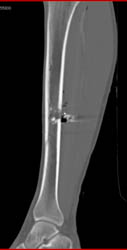 GSW Tibia - CTisus CT Scan