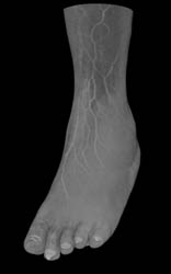 Cellulitis - CTisus CT Scan