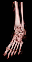 Cellulitis - CTisus CT Scan