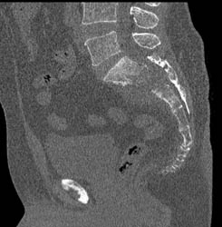 Chordoma - CTisus CT Scan