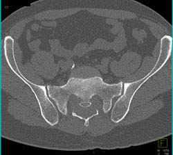 Chordoma - CTisus CT Scan