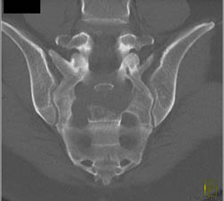 Chordoma - CTisus CT Scan