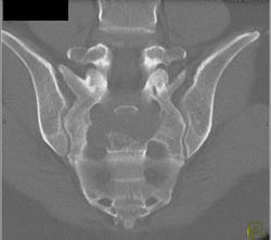 Chordoma - CTisus CT Scan