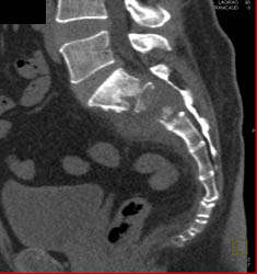 Chordoma - CTisus CT Scan