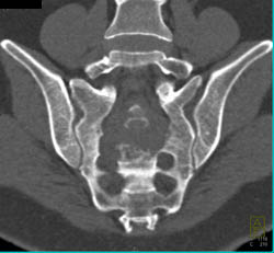 Chordoma - CTisus CT Scan