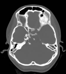 Chondrosarcoma of the Base of the Skull - CTisus CT Scan