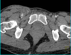 Bleed in Right Superficial Femoral Artery With CT Angiogram - CTisus CT Scan