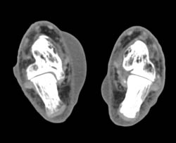 Bullous Inflammation Inner Aspect Foot - CTisus CT Scan