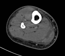 Gastrocnemius Bleed - CTisus CT Scan