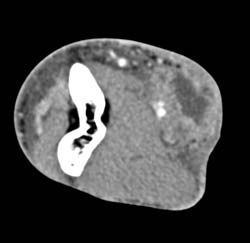 Abscess Near Elbow - CTisus CT Scan