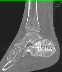 Poor Healing of Calcaneal Fracture - CTisus CT Scan