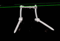 3D Mapping Post Repair With 3D Imaging of Hardware - CTisus CT Scan