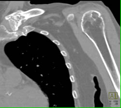 Benign Cyst Humerus - CTisus CT Scan