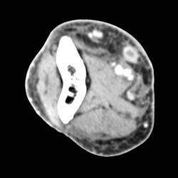 Venous Thrombosis - CTisus CT Scan