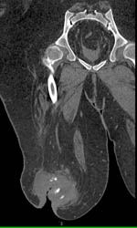 Osteomyelitis at Stump With Infection - CTisus CT Scan