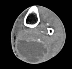 Abscess in Popliteal Fossa - CTisus CT Scan