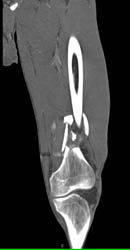 Distal Femur Fracture Without Vascular Injury - CTisus CT Scan