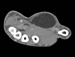 Lipoma in Hand - CTisus CT Scan