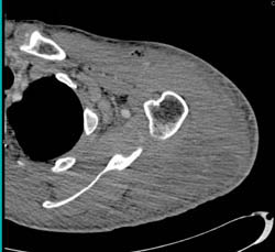 Myositis Shoulder - CTisus CT Scan