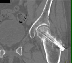 Pins Across Femur Fracture - CTisus CT Scan