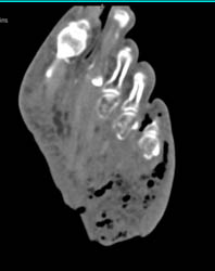 Ulceration With Gangrene of the Foot - CTisus CT Scan