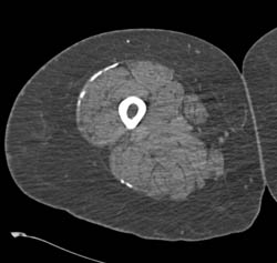 Scleroderma - CTisus CT Scan