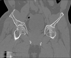 Hip Deformity - CTisus CT Scan