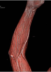 CTA Arm With Puncture Wound - CTisus CT Scan