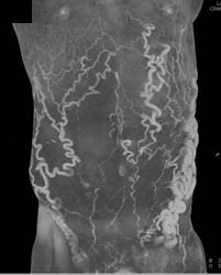 Subcutaneous Collaterals Due to IVC Occlusion - CTisus CT Scan