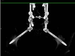 3D Increases Detail of Hardware - CTisus CT Scan