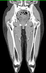 Thigh Hematoma S/P GSW - CTisus CT Scan