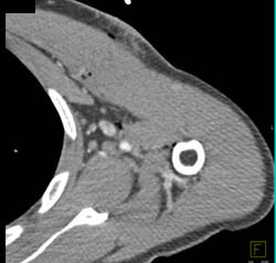 GSW Axilla Without Vascular Injury Using Edits - CTisus CT Scan