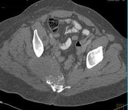 Neurogenic Tumor Invades Sacrum - CTisus CT Scan