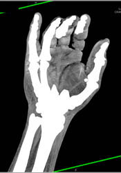 Cellulitis - CTisus CT Scan